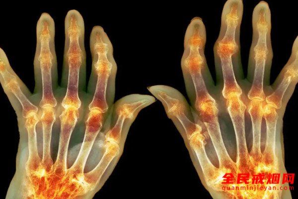 常年吸烟者更易患风湿性关节炎，抽烟对类风湿关节炎病人有害吗