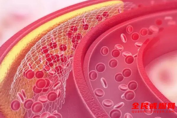 长期吸烟可导致深静脉血栓（DVT），吸烟对深静脉血栓的危害